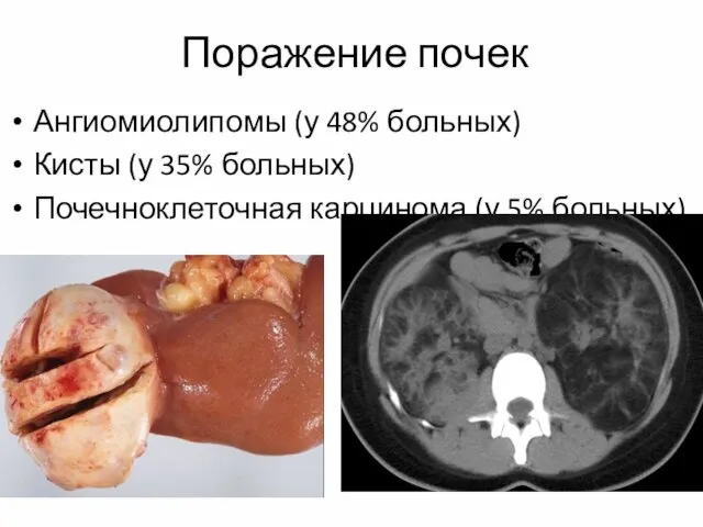 Поражение почек Ангиомиолипомы (у 48% больных) Кисты (у 35% больных) Почечноклеточная карцинома (у 5% больных)