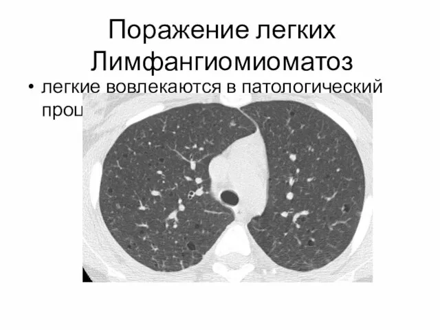 Поражение легких Лимфангиомиоматоз легкие вовлекаются в патологический процесс после 30 лет