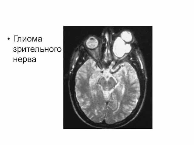 Глиома зрительного нерва