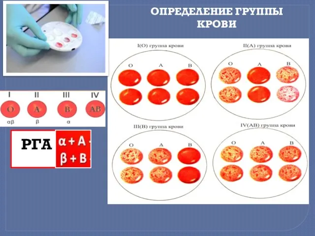 ОПРЕДЕЛЕНИЕ ГРУППЫ КРОВИ РГА