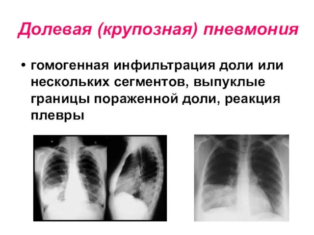 Долевая (крупозная) пневмония гомогенная инфильтрация доли или нескольких сегментов, выпуклые границы пораженной доли, реакция плевры