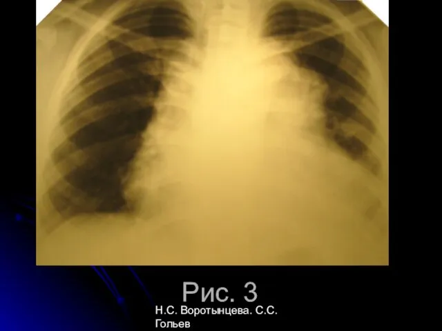 Н.С. Воротынцева. С.С. Гольев Рентгенопульмонология Рис. 3