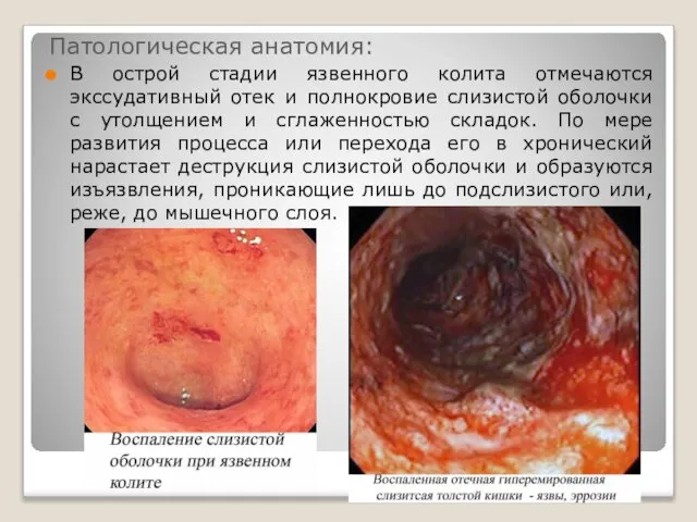 Патологическая анатомия: В острой стадии язвенного колита отмечаются экссудативный отек и