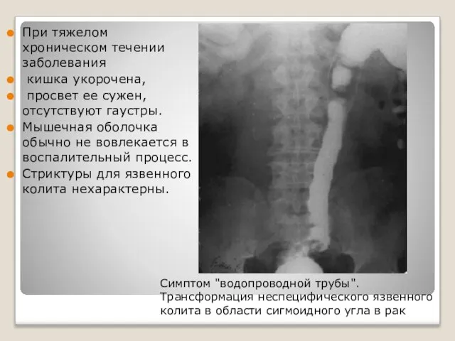 При тяжелом хроническом течении заболевания кишка укорочена, просвет ее сужен, отсутствуют