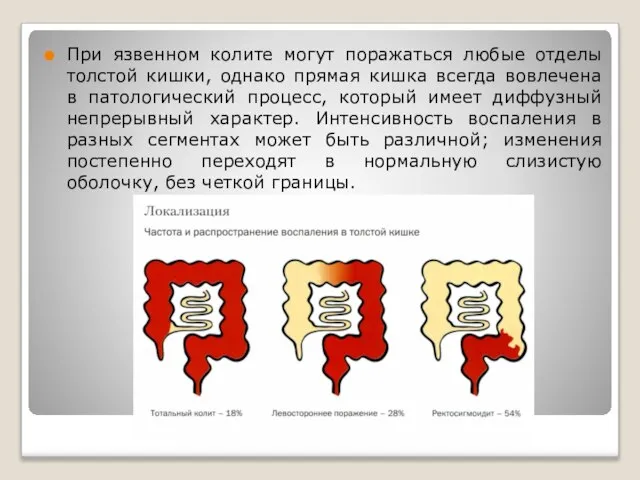 При язвенном колите могут поражаться любые отделы толстой кишки, однако прямая