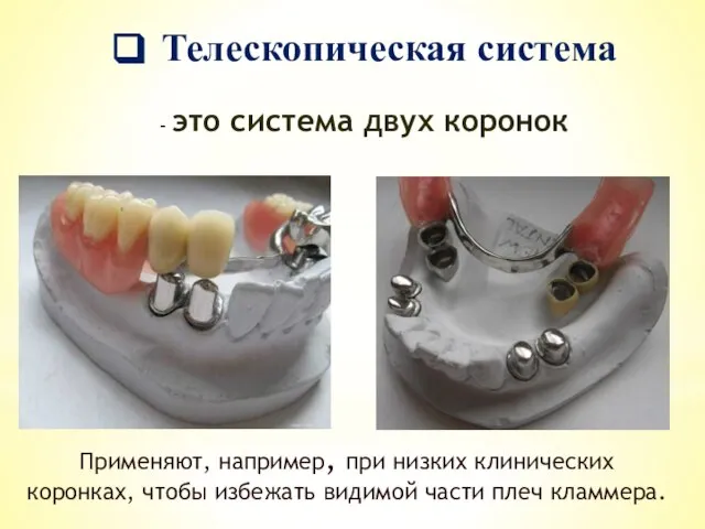 Телескопическая система - это система двух коронок Применяют, например, при низких