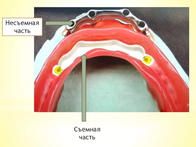 Несъемная часть Съемная часть