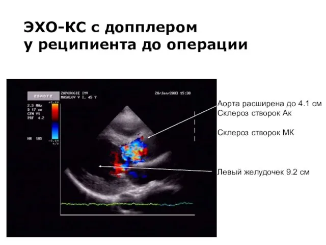 ЭХО-КС с допплером у реципиента до операции Аорта расширена до 4.1