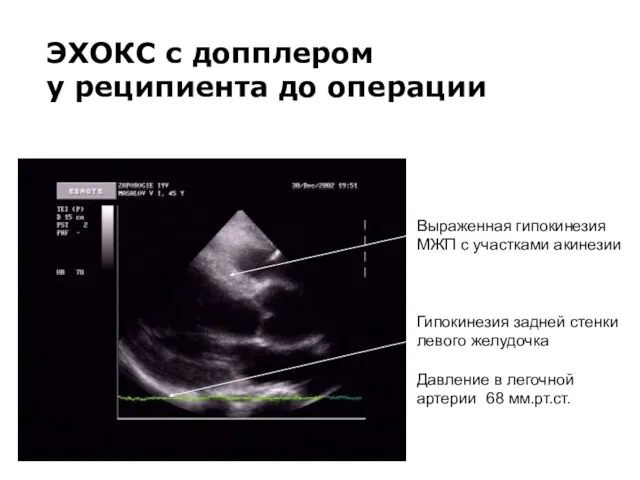 ЭХОКС с допплером у реципиента до операции Выраженная гипокинезия МЖП с