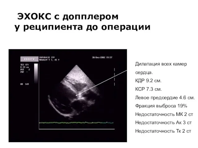 ЭХОКС с допплером у реципиента до операции Дилатация всех камер сердца.