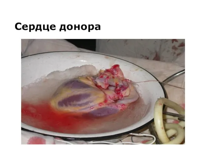 Сердце донора