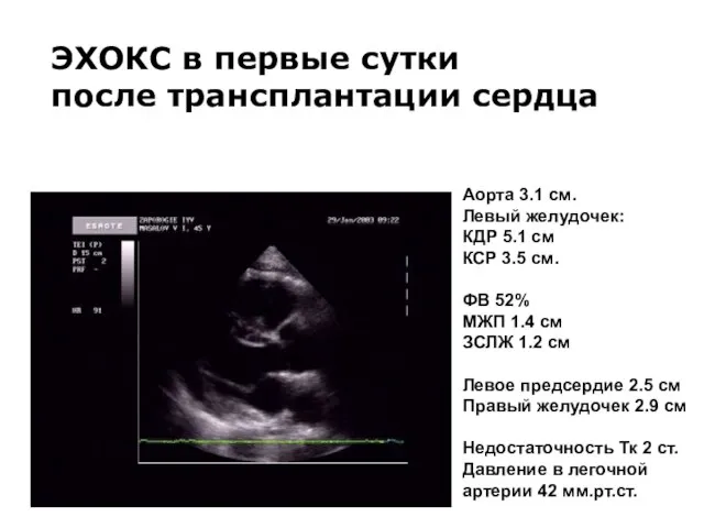 ЭХОКС в первые сутки после трансплантации сердца Аорта 3.1 см. Левый