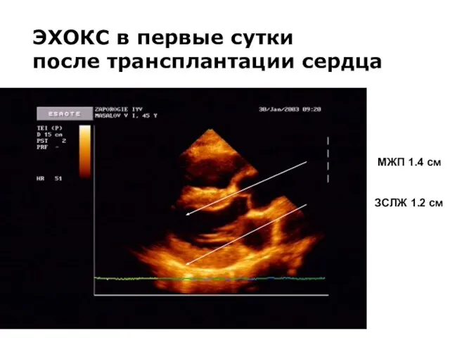 ЭХОКС в первые сутки после трансплантации сердца МЖП 1.4 см ЗСЛЖ 1.2 см