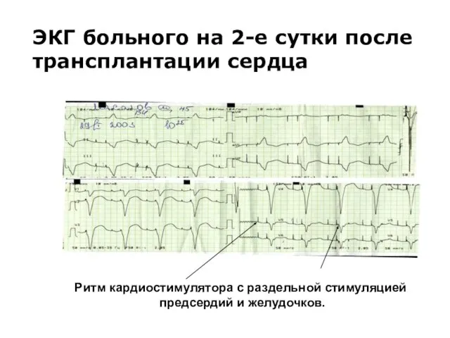 ЭКГ больного на 2-е сутки после трансплантации сердца Ритм кардиoстимулятора с раздельной стимуляцией предсердий и желудочков.