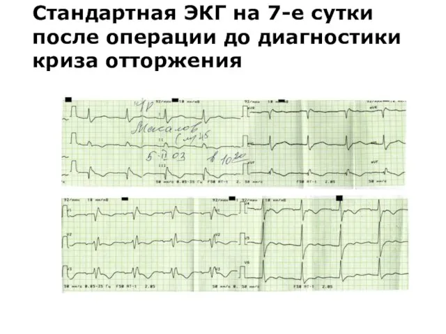 Стандартная ЭКГ на 7-е сутки после операции до диагностики криза отторжения