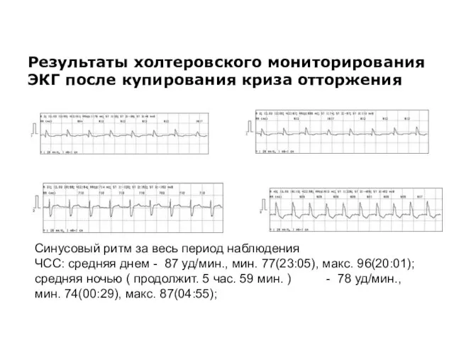 Результаты холтеровского мониторирования ЭКГ после купирования криза отторжения Синусовый ритм за