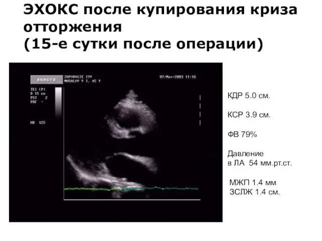 ЭХОКС после купирования криза отторжения (15-е сутки после операции) КДР 5.0