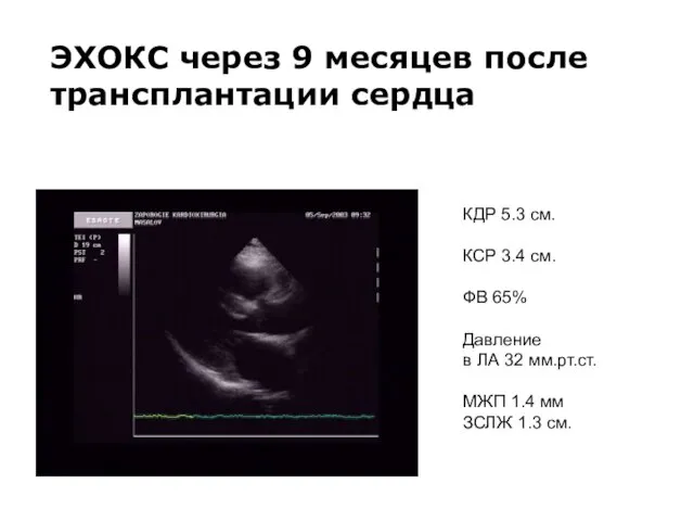 ЭХОКС через 9 месяцев после трансплантации сердца КДР 5.3 см. КСР