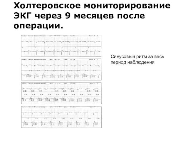 Холтеровское мониторирование ЭКГ через 9 месяцев после операции. Синусовый ритм за весь период наблюдения