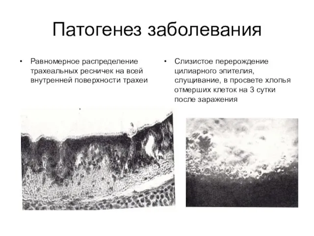 Патогенез заболевания Равномерное распределение трахеальных ресничек на всей внутренней поверхности трахеи