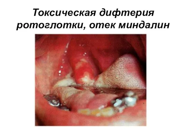 Токсическая дифтерия ротоглотки, отек миндалин