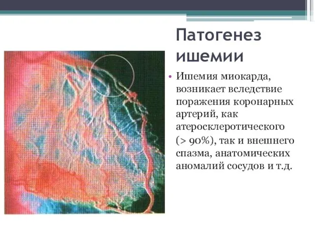 Патогенез ишемии Ишемия миокарда, возникает вследствие поражения коронарных артерий, как атеросклеротического