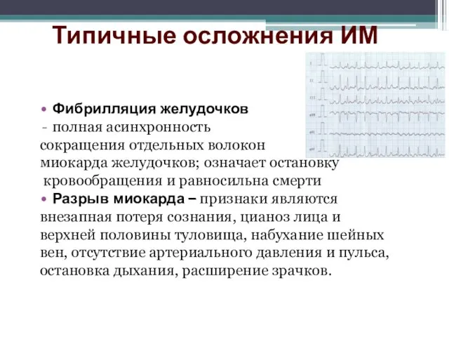 Типичные осложнения ИМ Фибрилляция желудочков полная асинхронность сокращения отдельных волокон миокарда