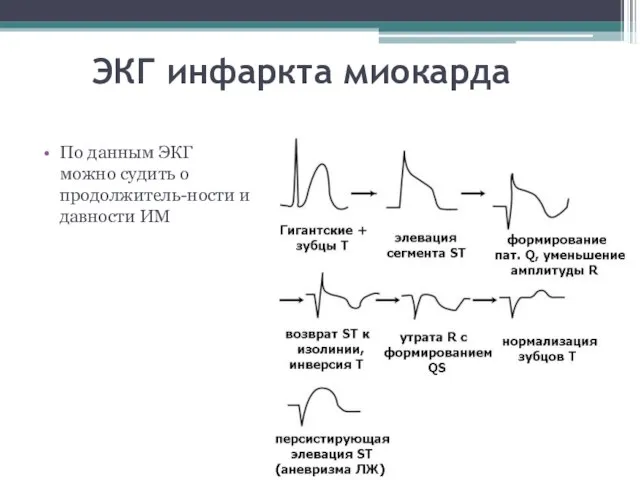 ЭКГ инфаркта миокарда По данным ЭКГ можно судить о продолжитель-ности и давности ИМ