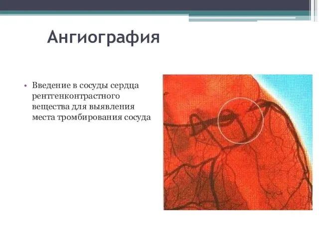 Ангиография Введение в сосуды сердца рентгенконтрастного вещества для выявления места тромбирования сосуда