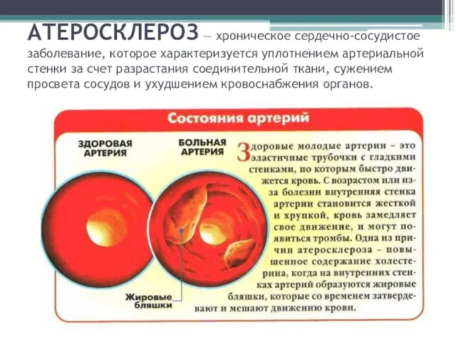 АТЕРОСКЛЕРОЗ — хроническое сердечно-сосудистое заболевание, которое характеризуется уплотнением артериальной стенки за