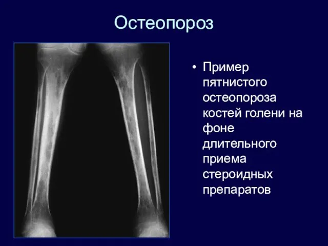 Остеопороз Пример пятнистого остеопороза костей голени на фоне длительного приема стероидных препаратов