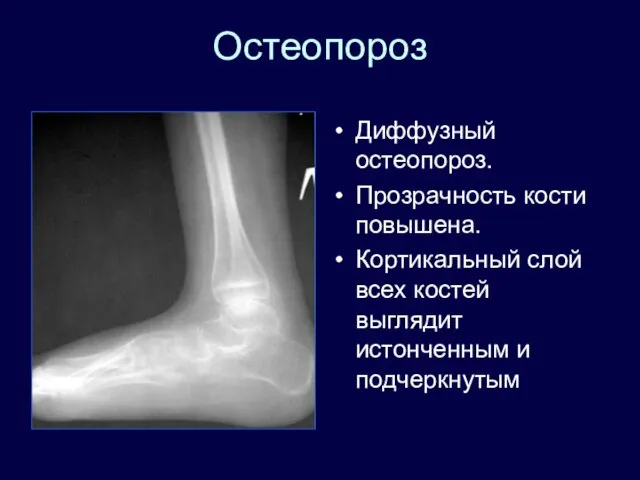 Остеопороз Диффузный остеопороз. Прозрачность кости повышена. Кортикальный слой всех костей выглядит истонченным и подчеркнутым