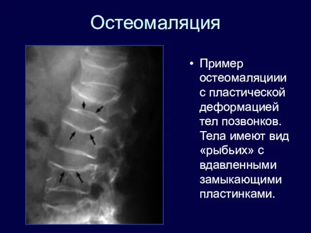 Остеомаляция Пример остеомаляциии с пластической деформацией тел позвонков. Тела имеют вид «рыбьих» с вдавленными замыкающими пластинками.