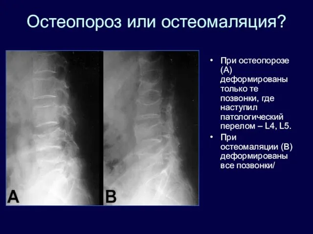 Остеопороз или остеомаляция? При остеопорозе (А) деформированы только те позвонки, где