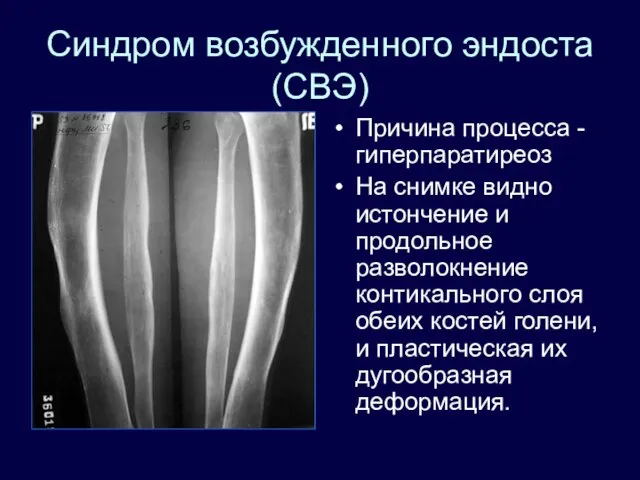 Синдром возбужденного эндоста (СВЭ) Причина процесса - гиперпаратиреоз На снимке видно