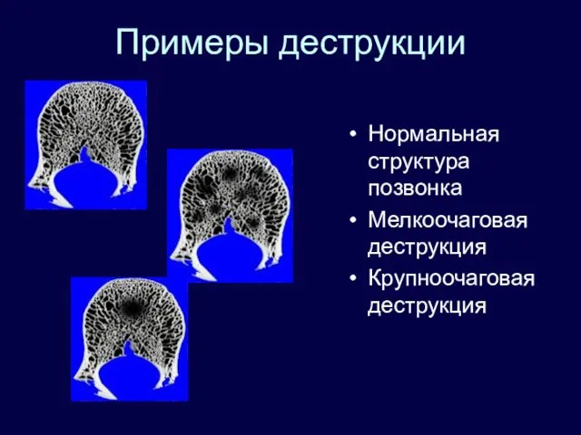 Примеры деструкции Нормальная структура позвонка Мелкоочаговая деструкция Крупноочаговая деструкция