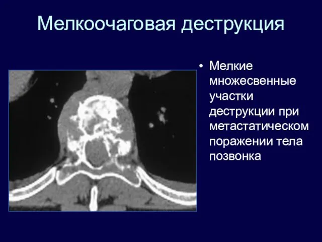 Мелкоочаговая деструкция Мелкие множесвенные участки деструкции при метастатическом поражении тела позвонка