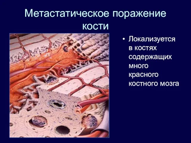 Метастатическое поражение кости Локализуется в костях содержащих много красного костного мозга