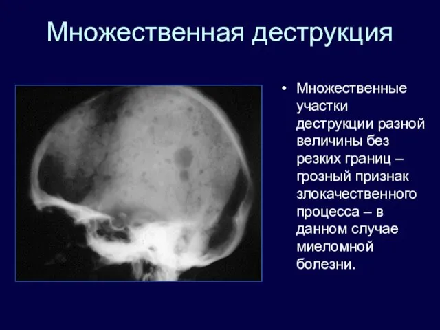 Множественная деструкция Множественные участки деструкции разной величины без резких границ –