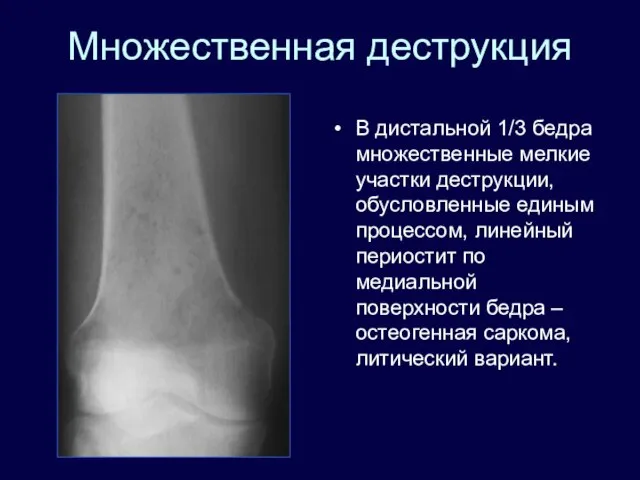 Множественная деструкция В дистальной 1/3 бедра множественные мелкие участки деструкции, обусловленные