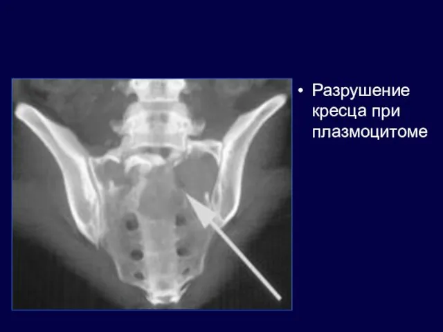 Разрушение кресца при плазмоцитоме