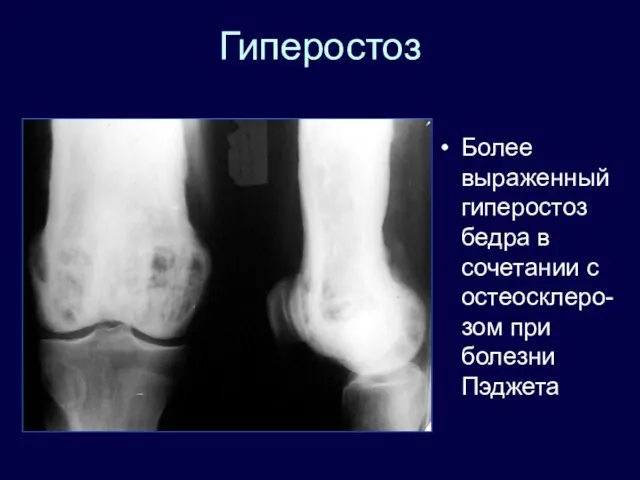 Гиперостоз Более выраженный гиперостоз бедра в сочетании с остеосклеро-зом при болезни Пэджета