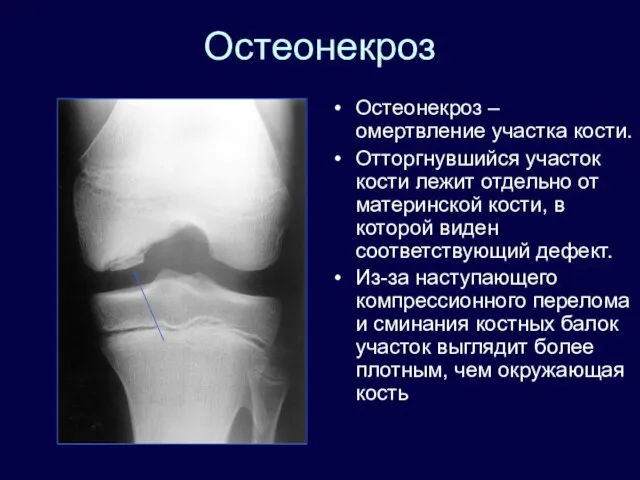 Остеонекроз Остеонекроз – омертвление участка кости. Отторгнувшийся участок кости лежит отдельно