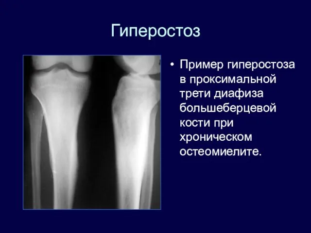 Гиперостоз Пример гиперостоза в проксимальной трети диафиза большеберцевой кости при хроническом остеомиелите.