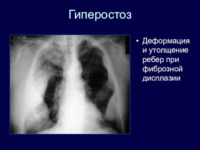 Гиперостоз Деформация и утолщение ребер при фиброзной дисплазии