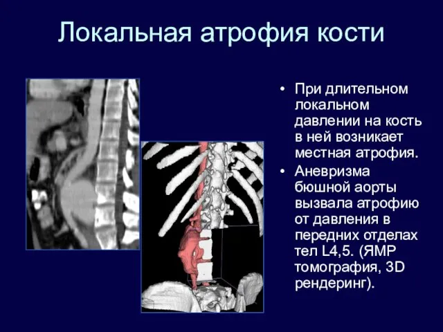 Локальная атрофия кости При длительном локальном давлении на кость в ней