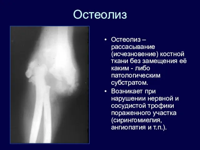 Остеолиз Остеолиз – рассасывание (исчезновение) костной ткани без замещения её каким