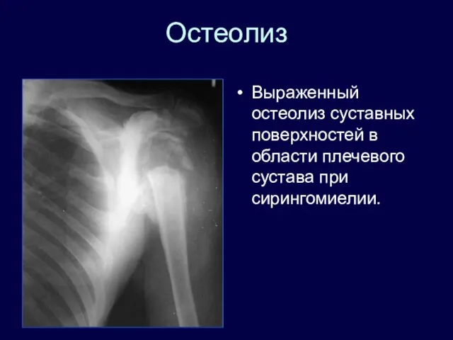 Остеолиз Выраженный остеолиз суставных поверхностей в области плечевого сустава при сирингомиелии.