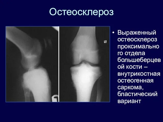 Остеосклероз Выраженный остеосклероз проксимального отдела большеберцевой кости – внутрикостная остеогенная саркома, бластический вариант