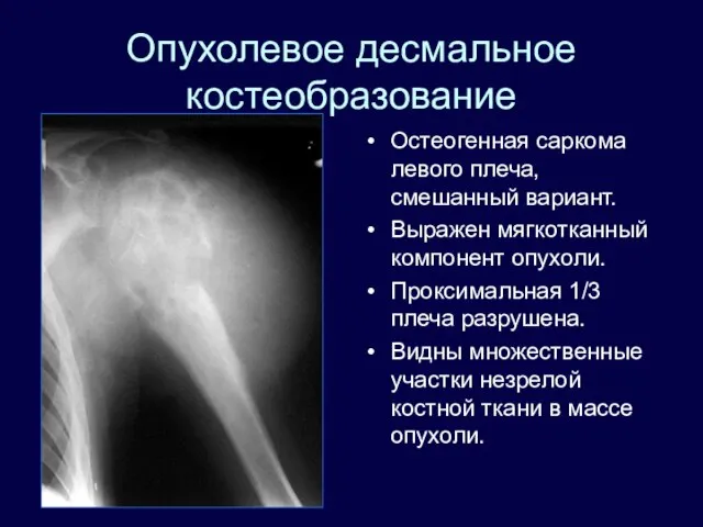 Опухолевое десмальное костеобразование Остеогенная саркома левого плеча, смешанный вариант. Выражен мягкотканный